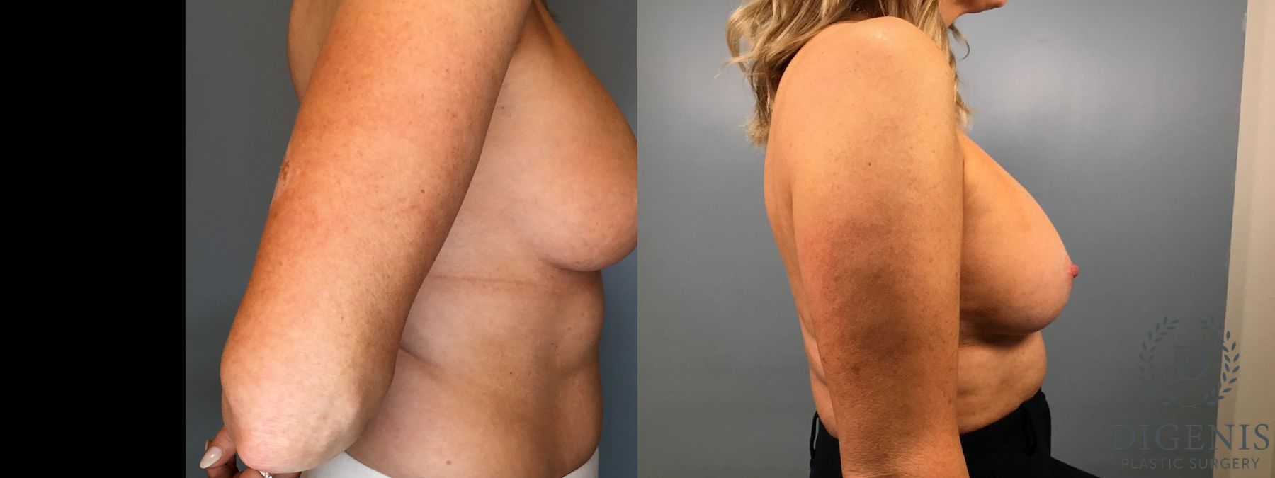 Before and after Breast Implant Exchange or Removal case 41360 - Angle 5