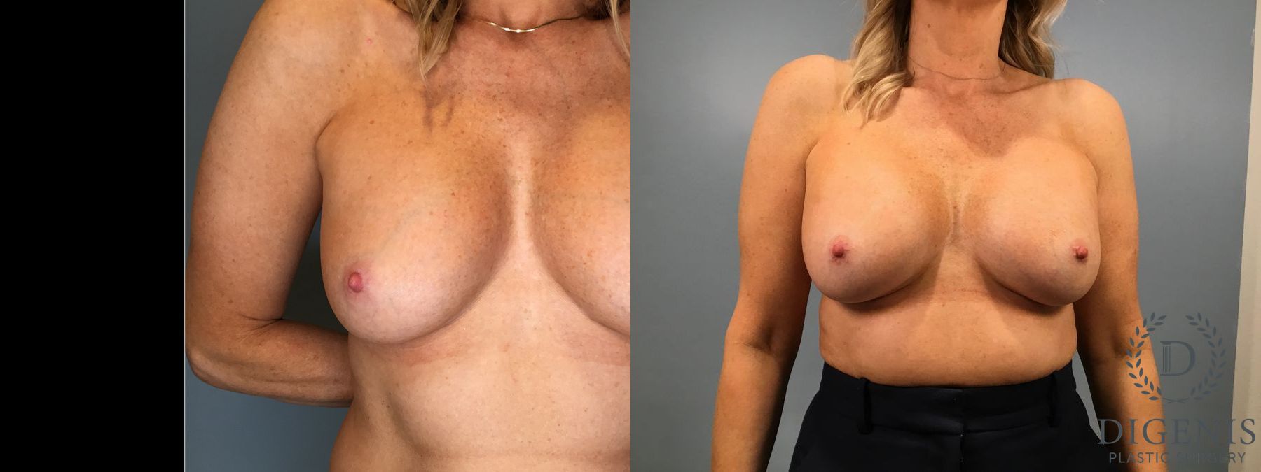 Before and after Breast Implant Exchange or Removal case 41360