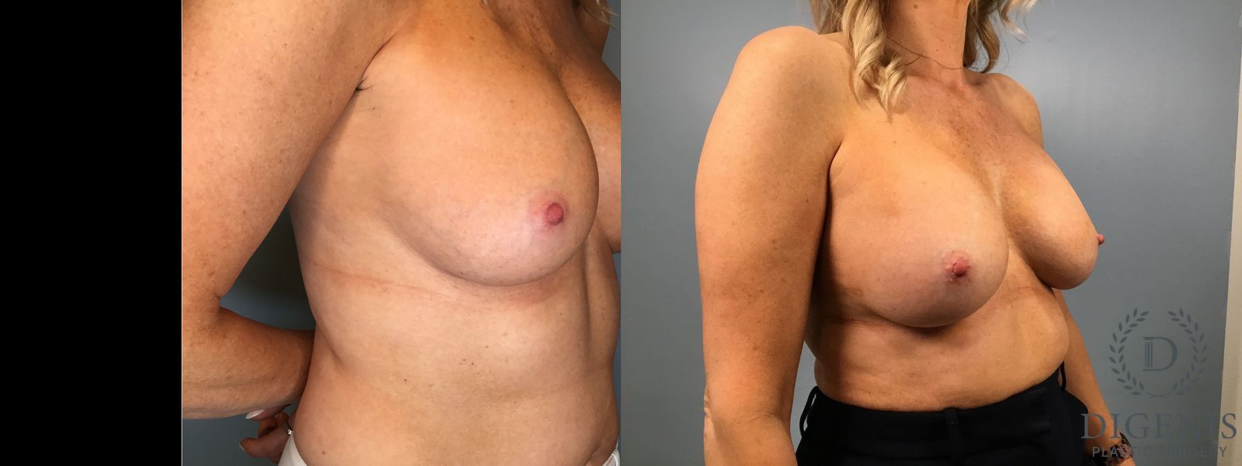 Before and after Breast Implant Exchange or Removal case 41360 - Angle 4