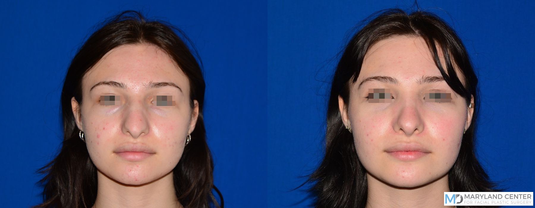 Before and after Rhinoplasty case 31710