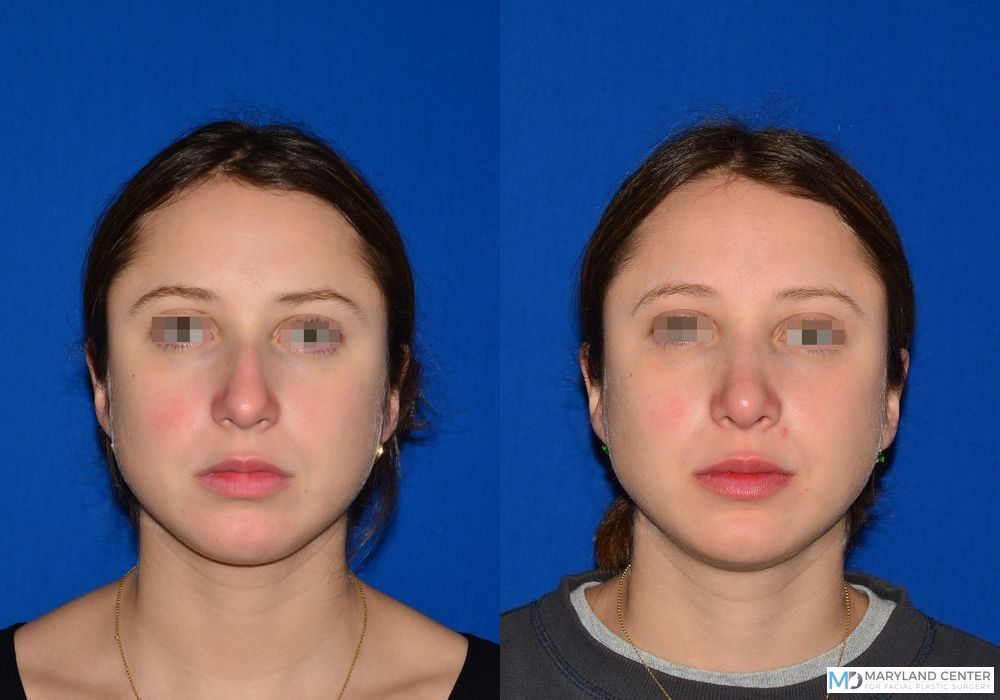 Before and after Rhinoplasty case 31714