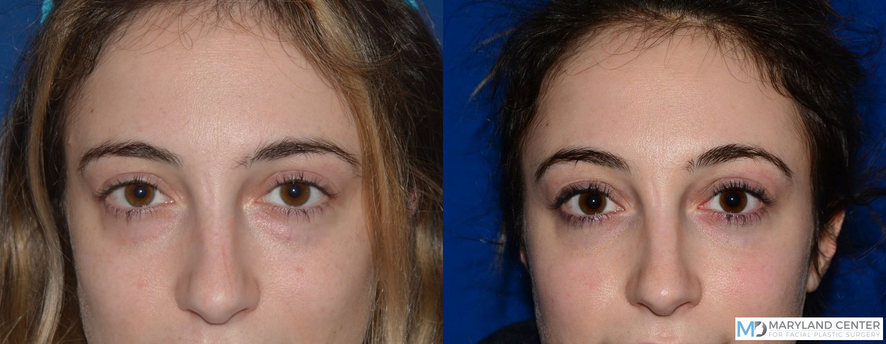 Before and after Blepharoplasty case 31775