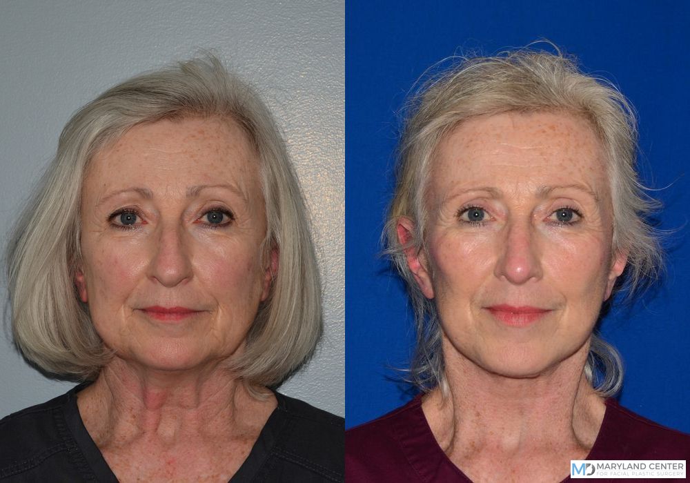 Before and after Rhinoplasty case 31739