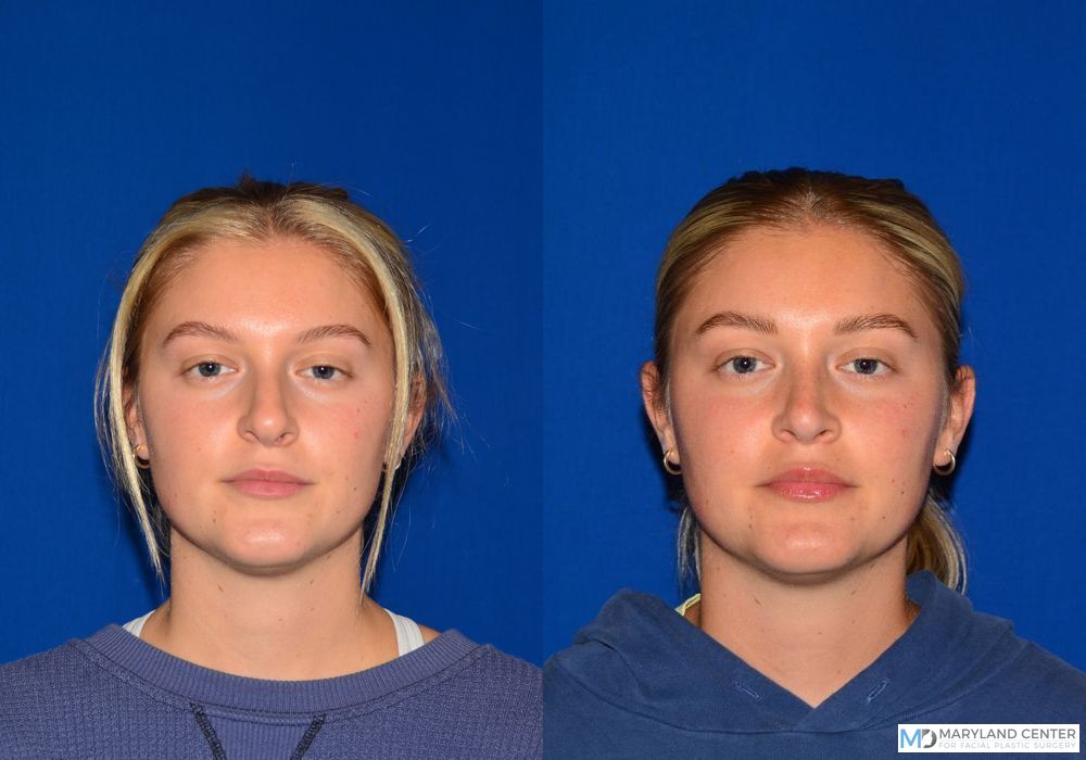 Before and after Rhinoplasty case 31718