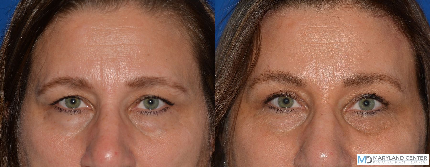 Before and after Blepharoplasty case 31687