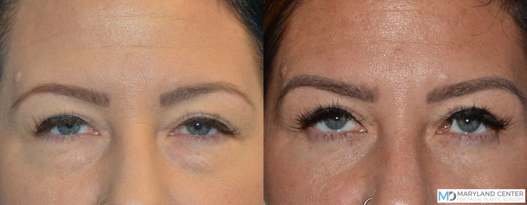 Before and after Blepharoplasty case 31688