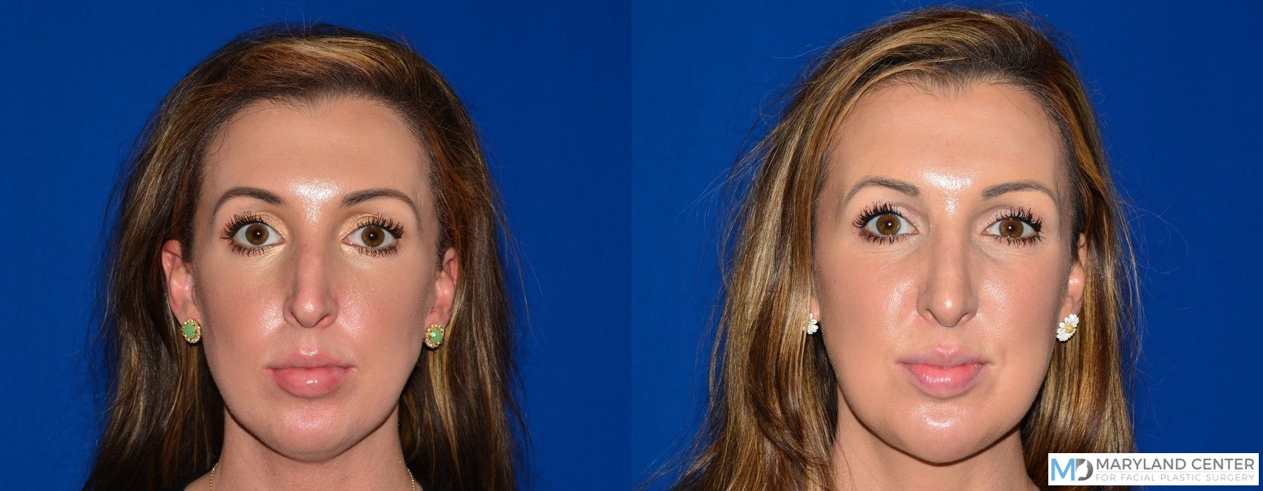Before and after Rhinoplasty case 31701