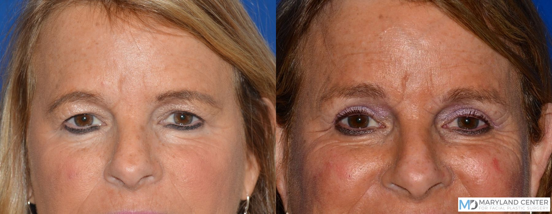 Before and after Blepharoplasty case 31776