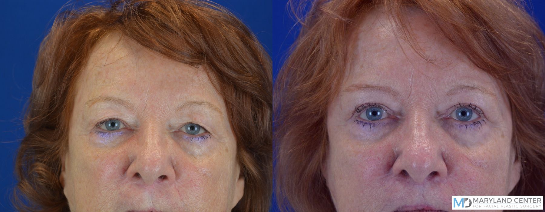 Before and after Blepharoplasty case 31767