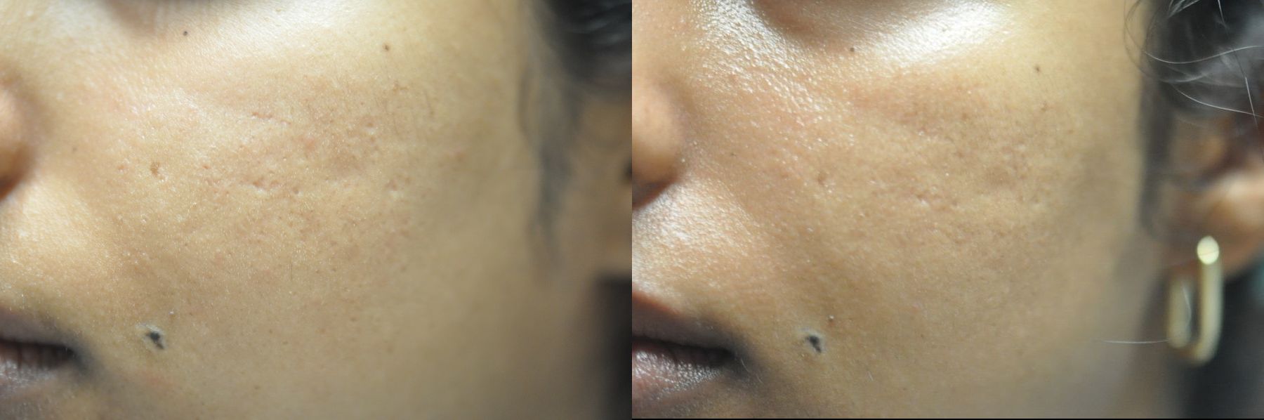 Before and after Acne Scars case 35521
