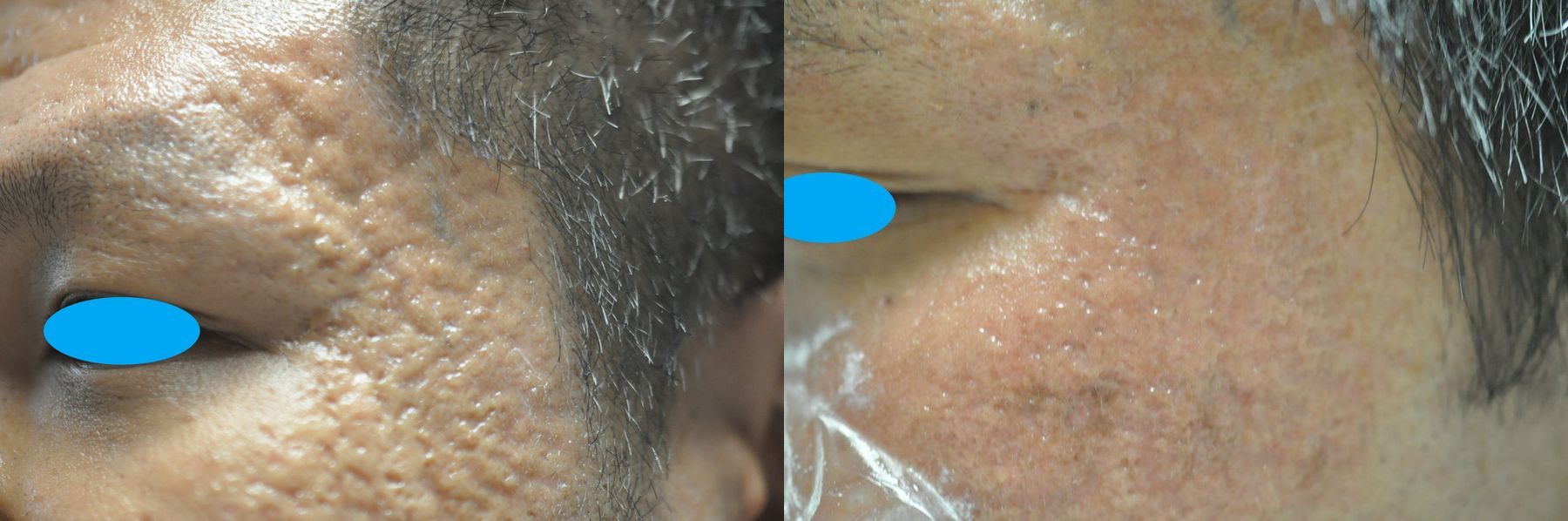 Before and after Acne Scars case 35797