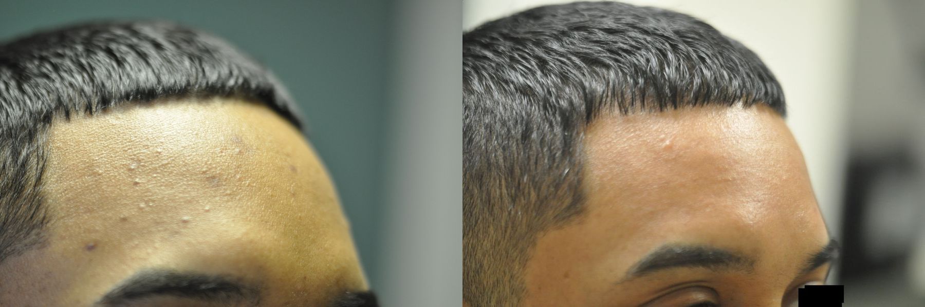 Before and after Acne Scars case 35729