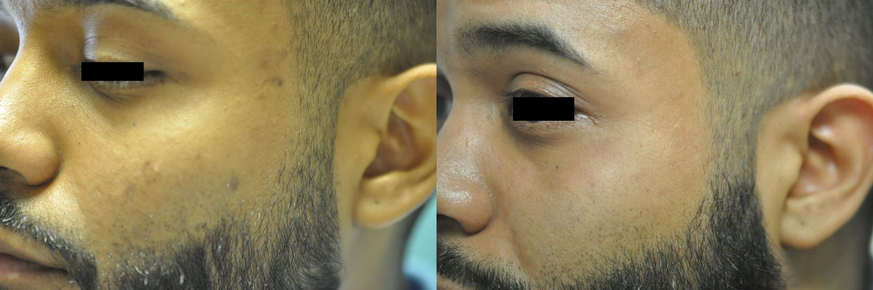 Before and after Acne Scars case 35729 - Angle 2