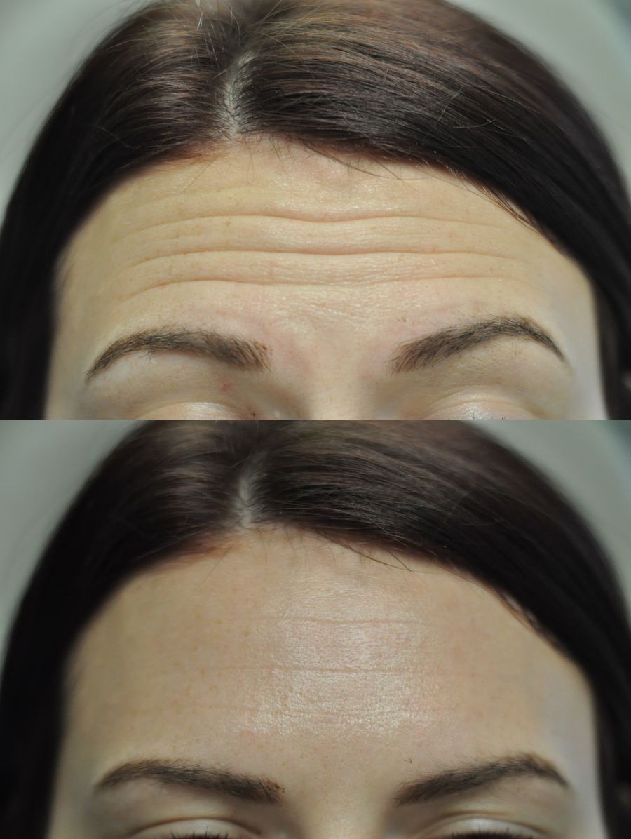 Before and after BOTOX® Cosmetic case 43723