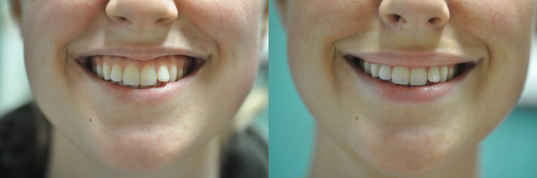Before and after BOTOX® Cosmetic case 35753