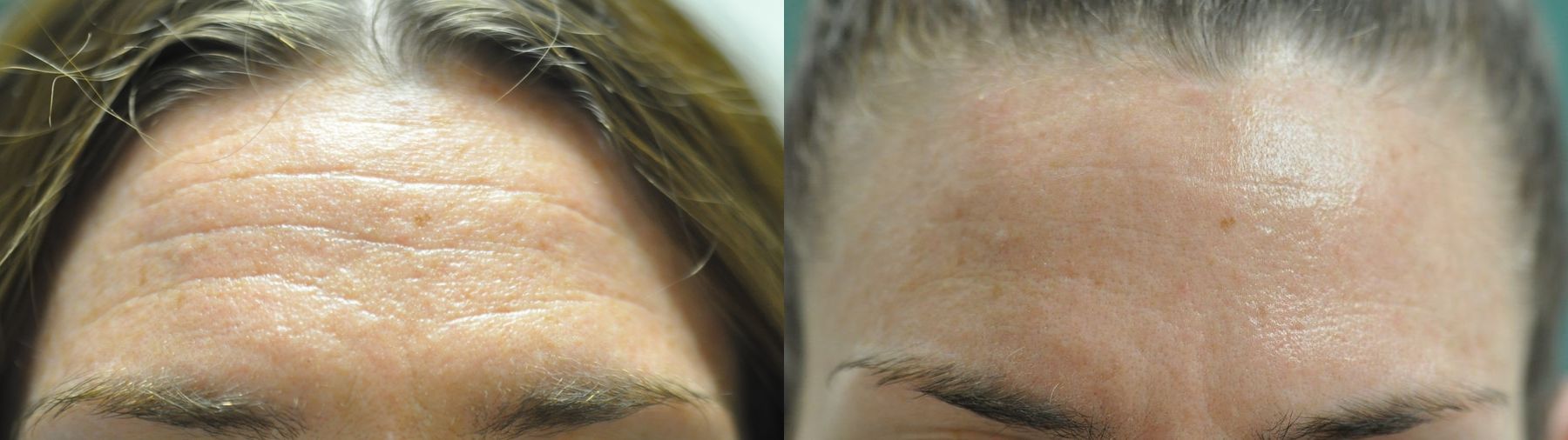 Before and after BOTOX® Cosmetic case 35806