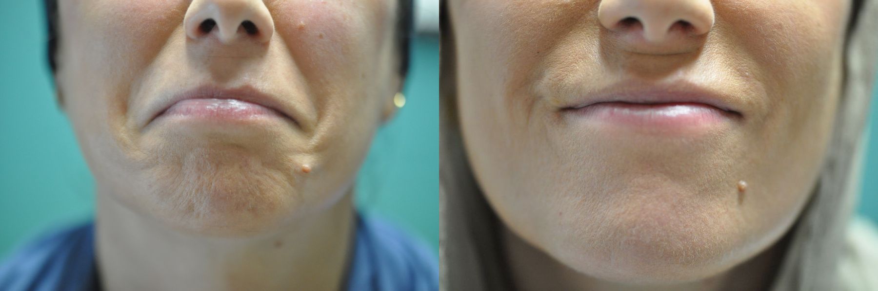 Before and after BOTOX® Cosmetic case 35815