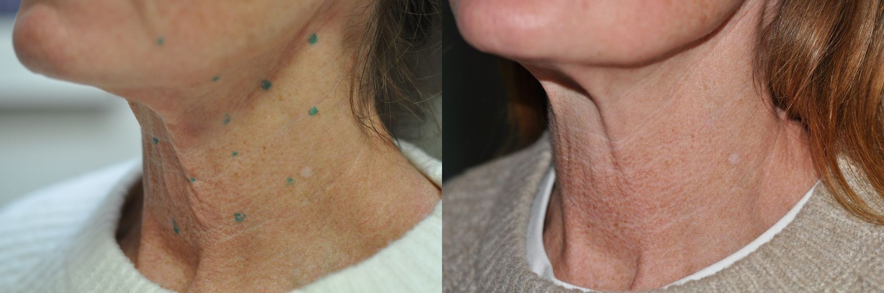 Before and after BOTOX® Cosmetic case 35707 - Angle 3