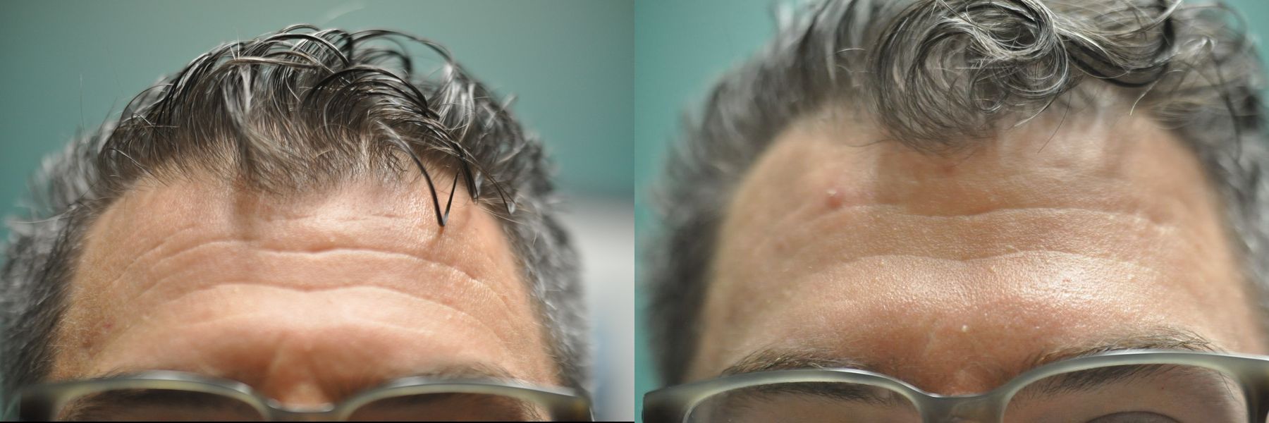 Before and after BOTOX® Cosmetic case 35764