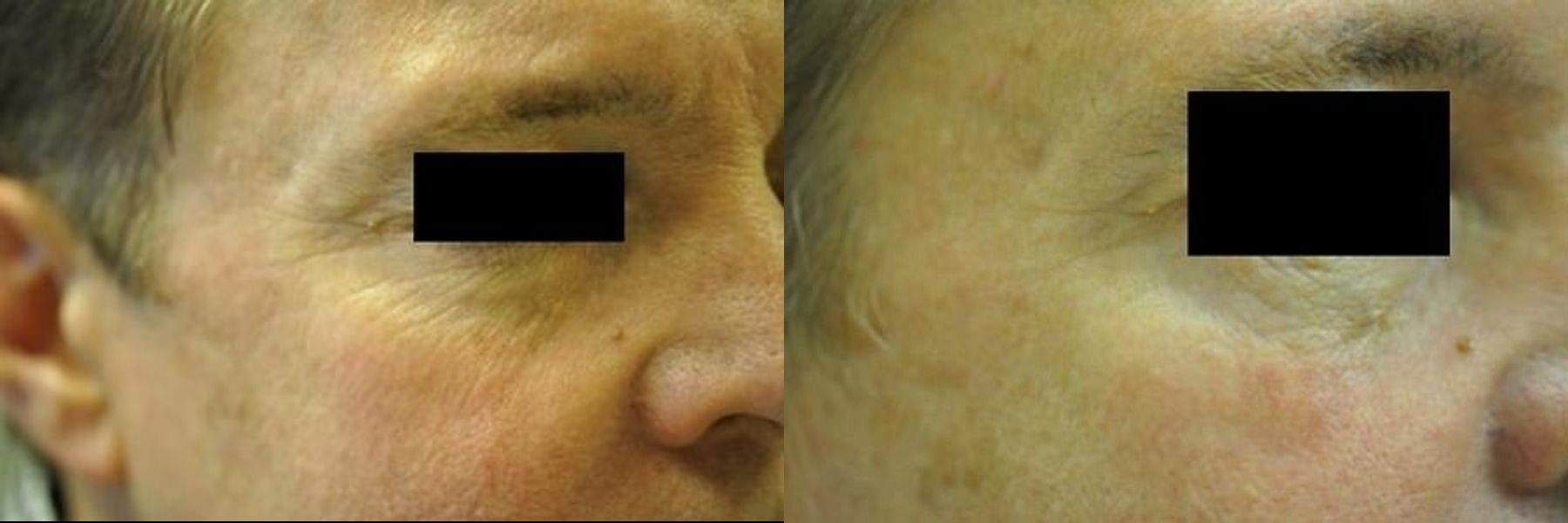 Before and after BOTOX® Cosmetic case 35474