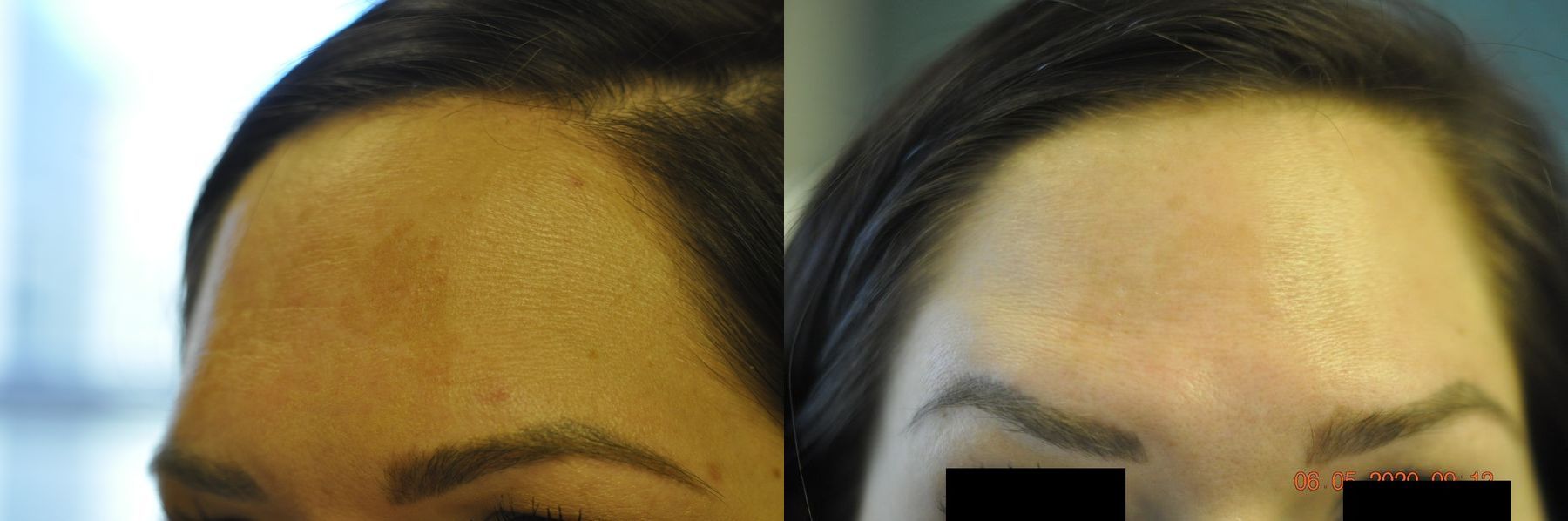 Before and after BOTOX® Cosmetic case 35745 - Angle 2