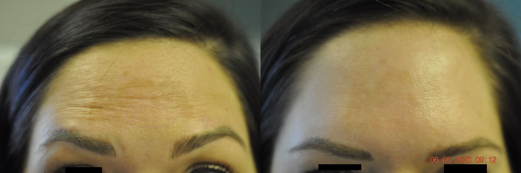 Before and after BOTOX® Cosmetic case 35745