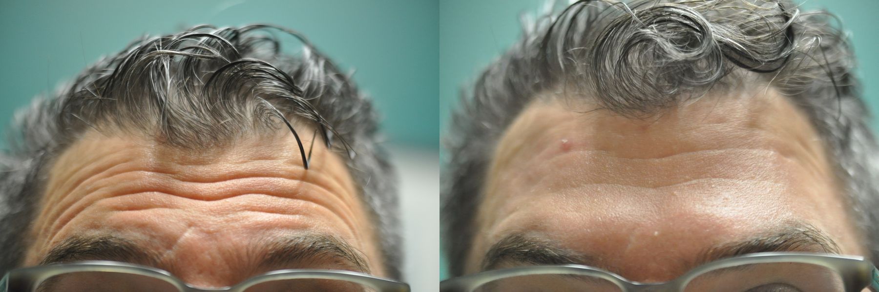 Before and after BOTOX® Cosmetic case 35764 - Angle 2