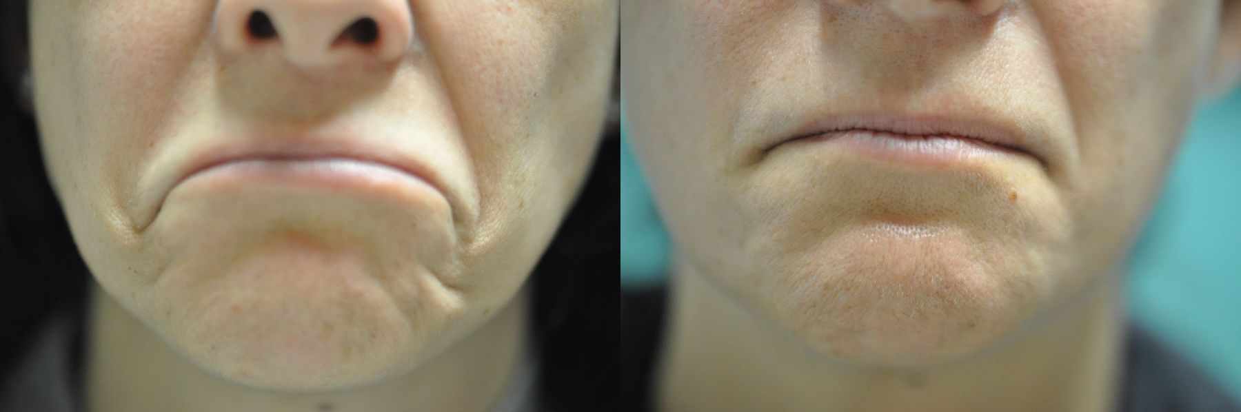 Before and after BOTOX® Cosmetic case 35765 - Angle 2