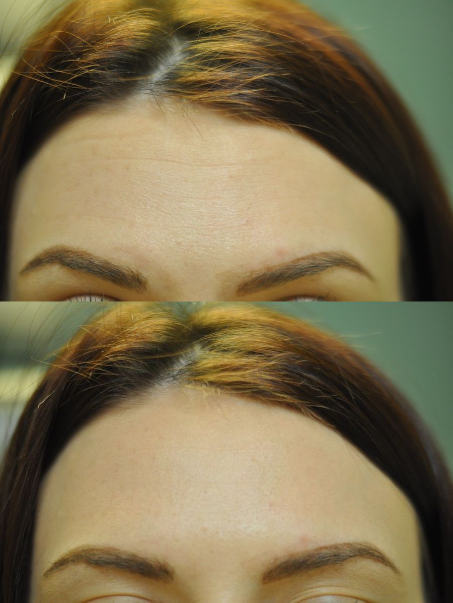 Before and after BOTOX® Cosmetic case 43723 - Angle 2