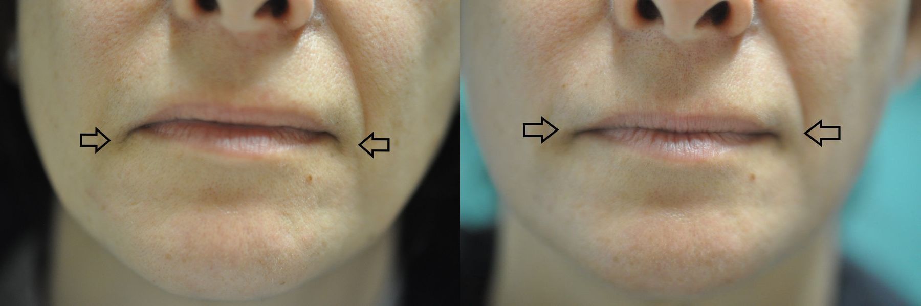 Before and after BOTOX® Cosmetic case 35765