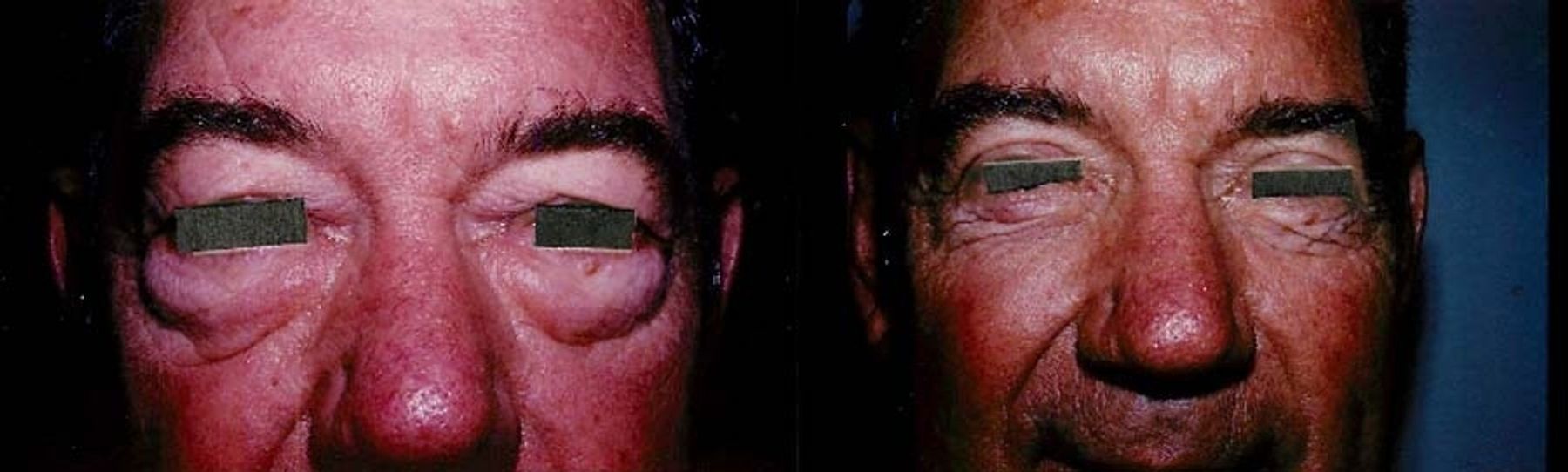 Before and after Blepharoplasty case 35473