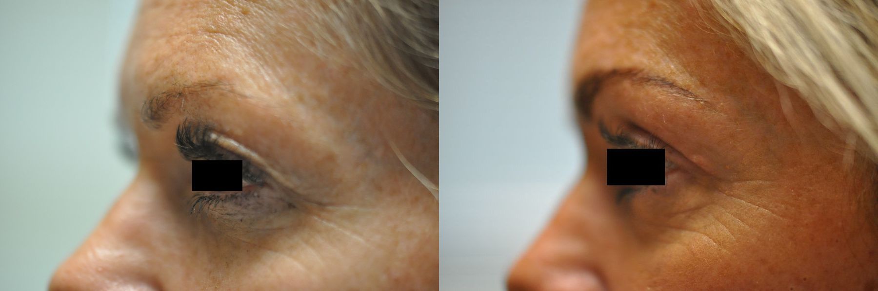 Before and after Blepharoplasty case 35330 - Angle 2