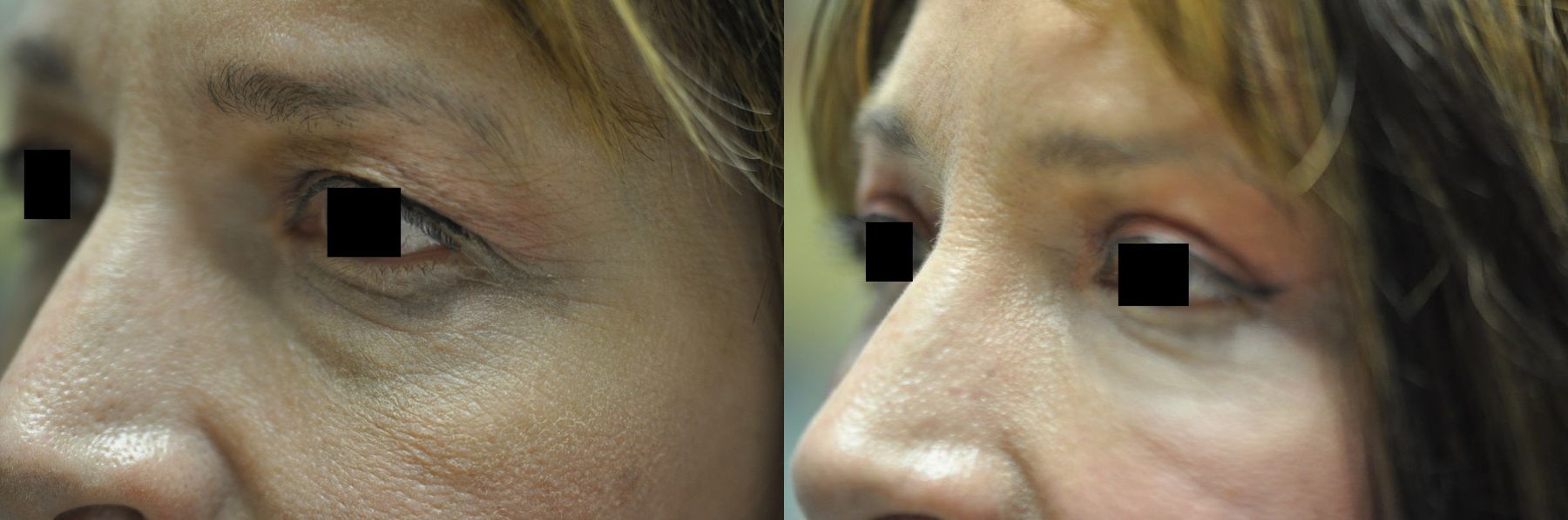 Before and after Blepharoplasty case 35370 - Angle 4