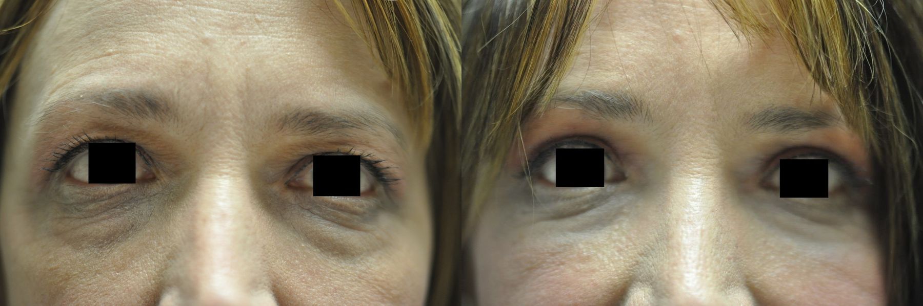 Before and after Blepharoplasty case 35370