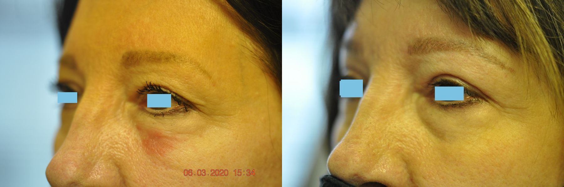 Before and after Blepharoplasty case 35430 - Angle 4