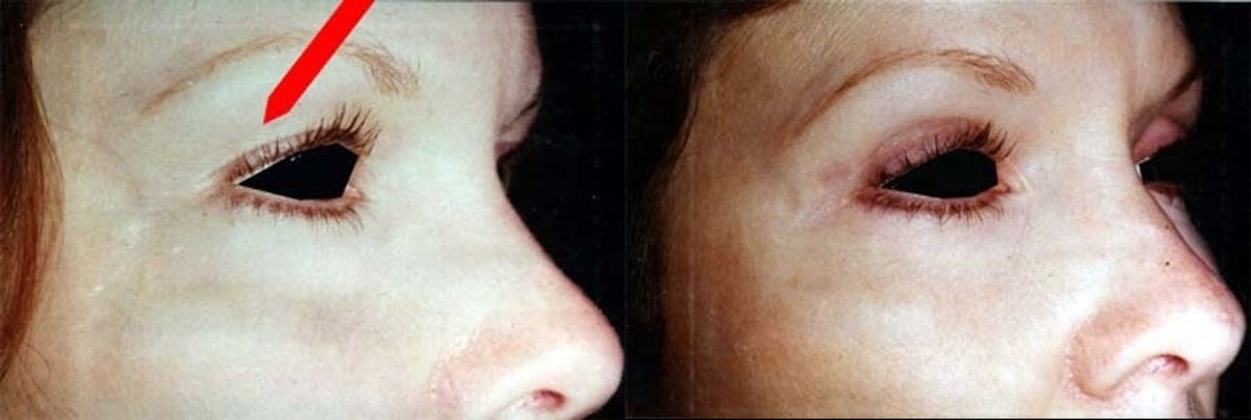 Before and after Blepharoplasty case 35461