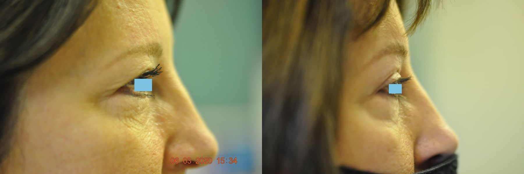 Before and after Blepharoplasty case 35430 - Angle 3