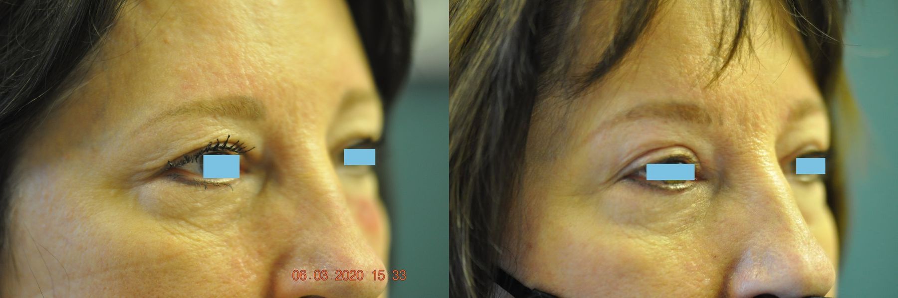 Before and after Blepharoplasty case 35430 - Angle 2