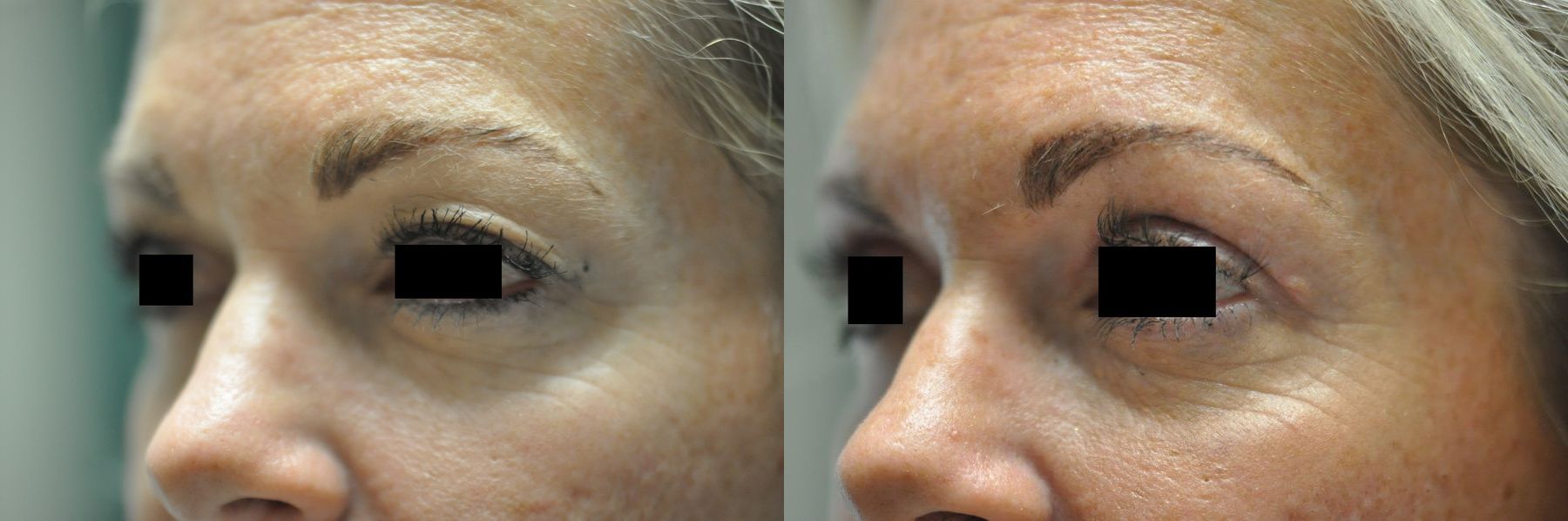 Before and after Blepharoplasty case 35330 - Angle 3