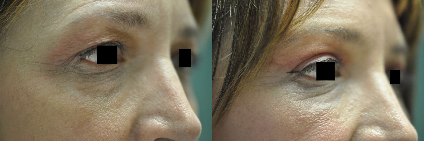 Before and after Blepharoplasty case 35370 - Angle 3