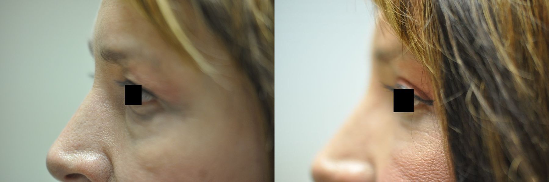 Before and after Blepharoplasty case 35370 - Angle 2