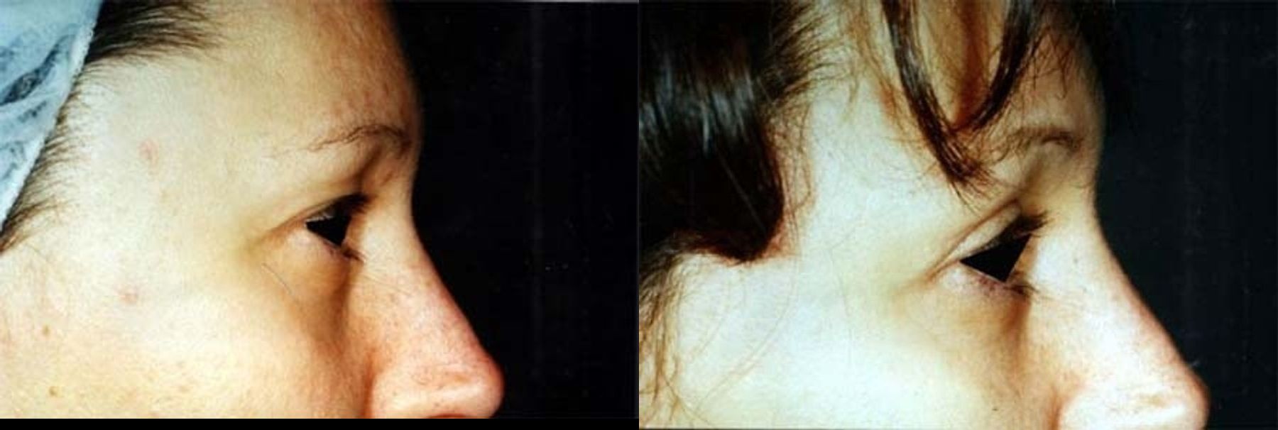 Before and after Blepharoplasty case 35416