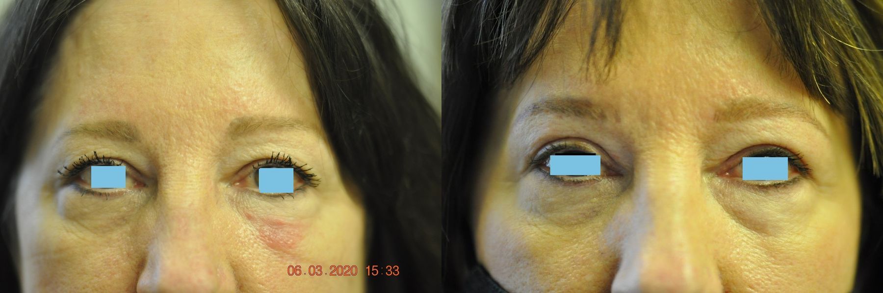 Before and after Blepharoplasty case 35430
