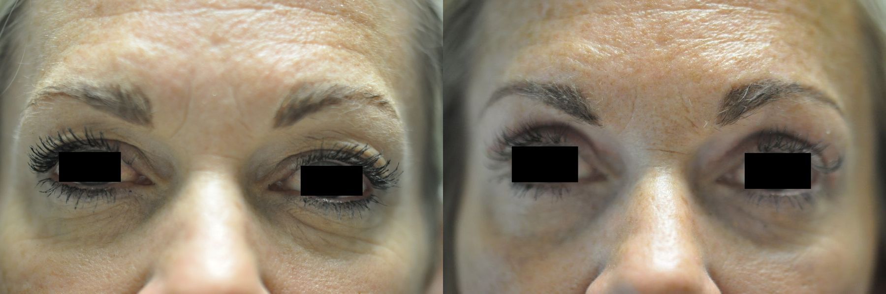 Before and after Blepharoplasty case 35330