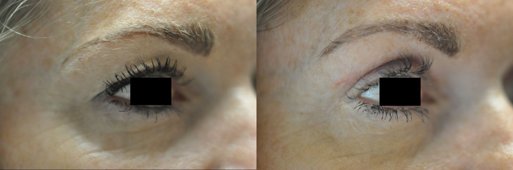 Before and after Blepharoplasty case 35330 - Angle 4