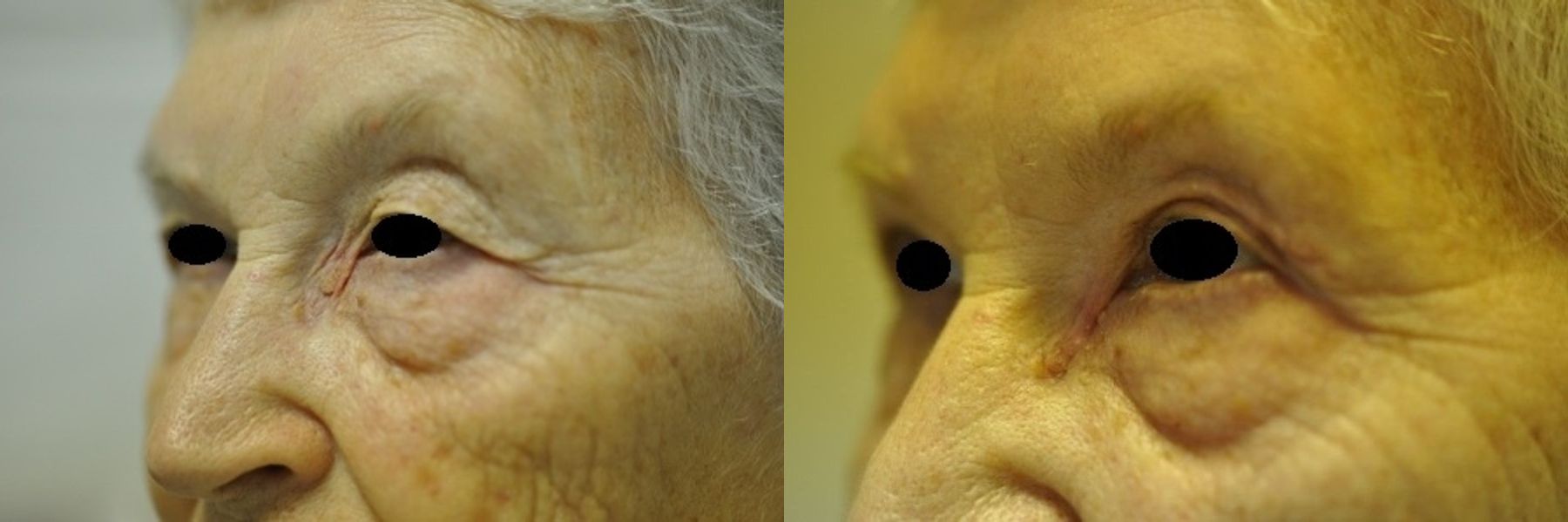 Before and after Blepharoplasty case 35451