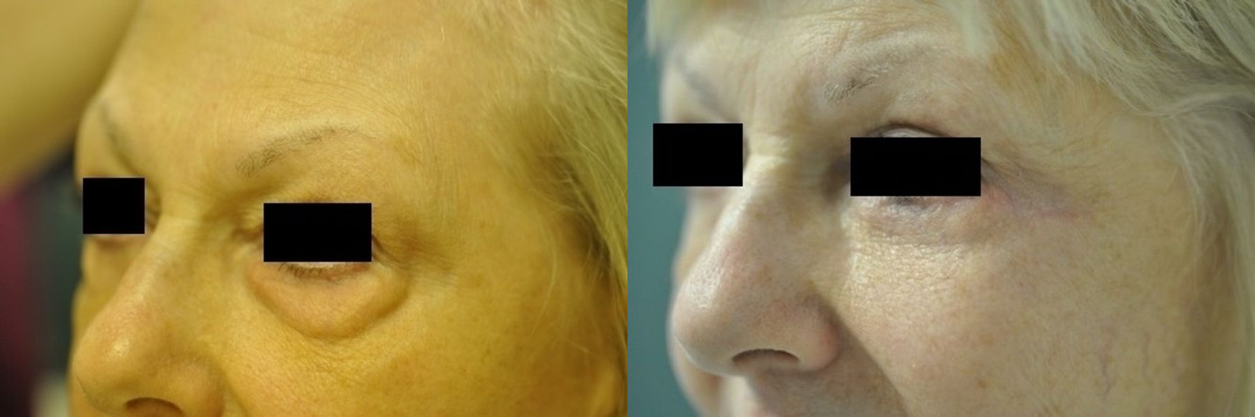 Before and after Blepharoplasty case 35458