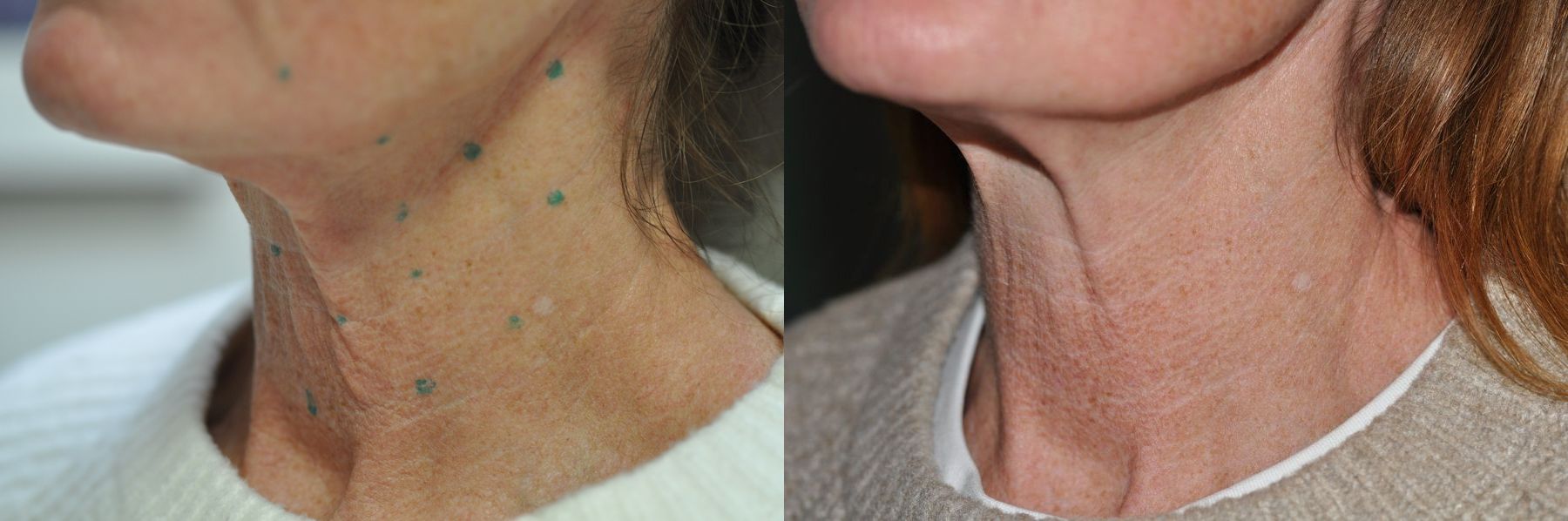 Before and after Botox Cosmetic- Neck case 35708 - Angle 3