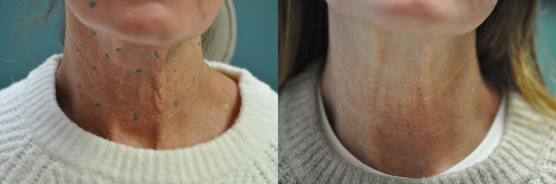 Before and after Botox Cosmetic- Neck case 35708 - Angle 2