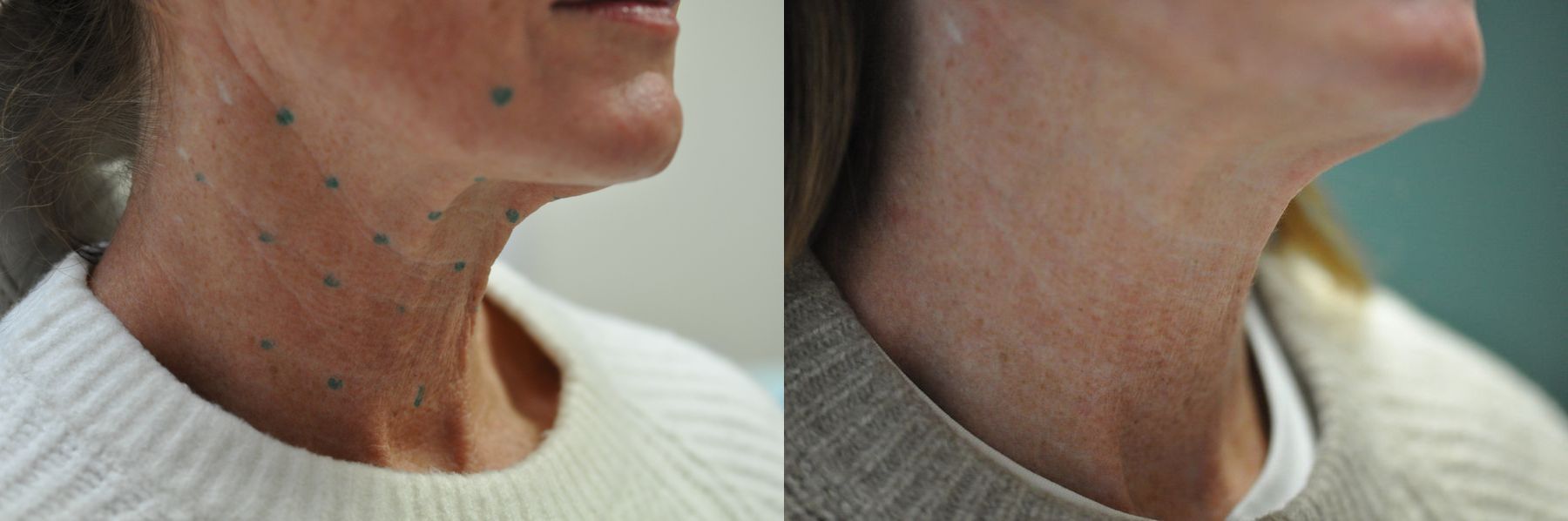 Before and after Botox Cosmetic- Neck case 35708